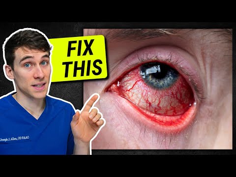 How to Get Rid of Red Eyes